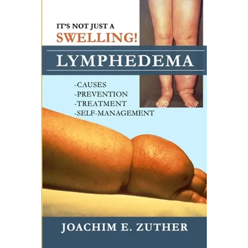 It's Not Just a Swelling! Lymphedema: Causes, Prevention, Treatment, Self-Management - Paperback