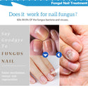 Powerful Nail Treatment Pen Onychomycosis Paronychia Anti Fungal Nail